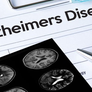 artificial-intelligence-detect-alzheimers-disease