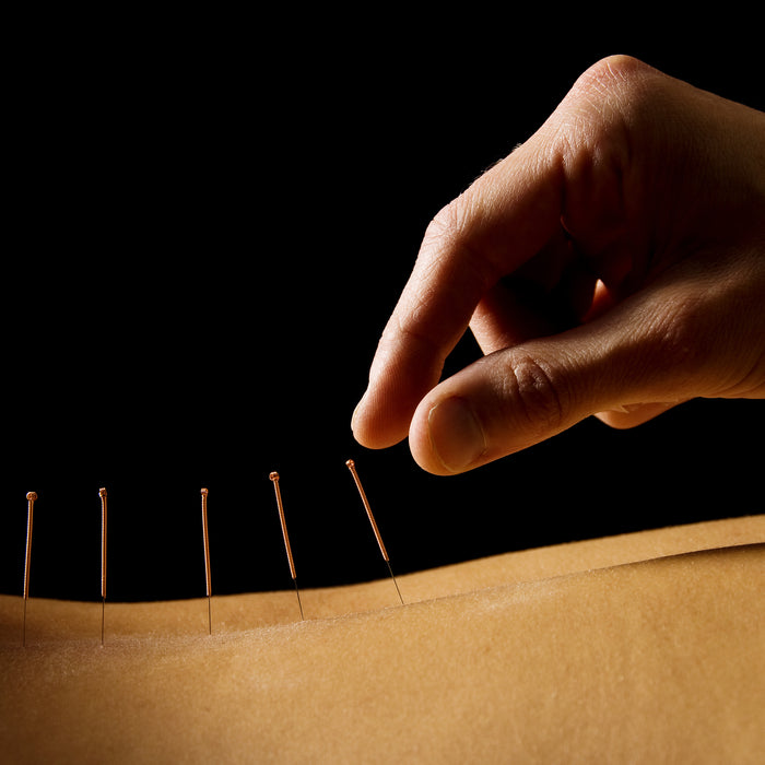 Why You Want to Use Acupuncture for Workout Recovery